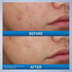  Limpiador Foaming Acné  Peróxido de Benzoilo 10% 150 ml