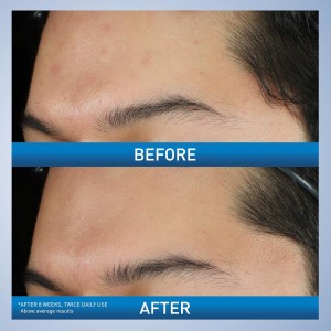  Limpiador Foaming Acné  Peróxido de Benzoilo 10% 150 ml